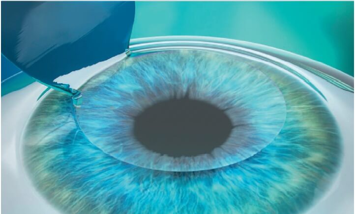 portland-lasik-update portland-lasik-update