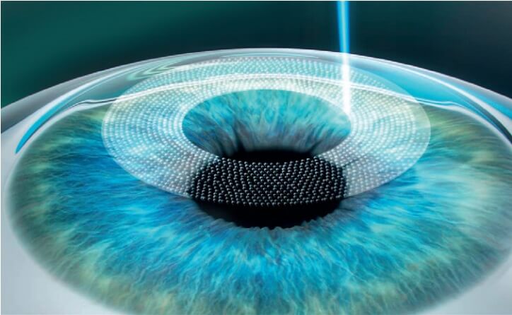 portland-lasik portland-lasik